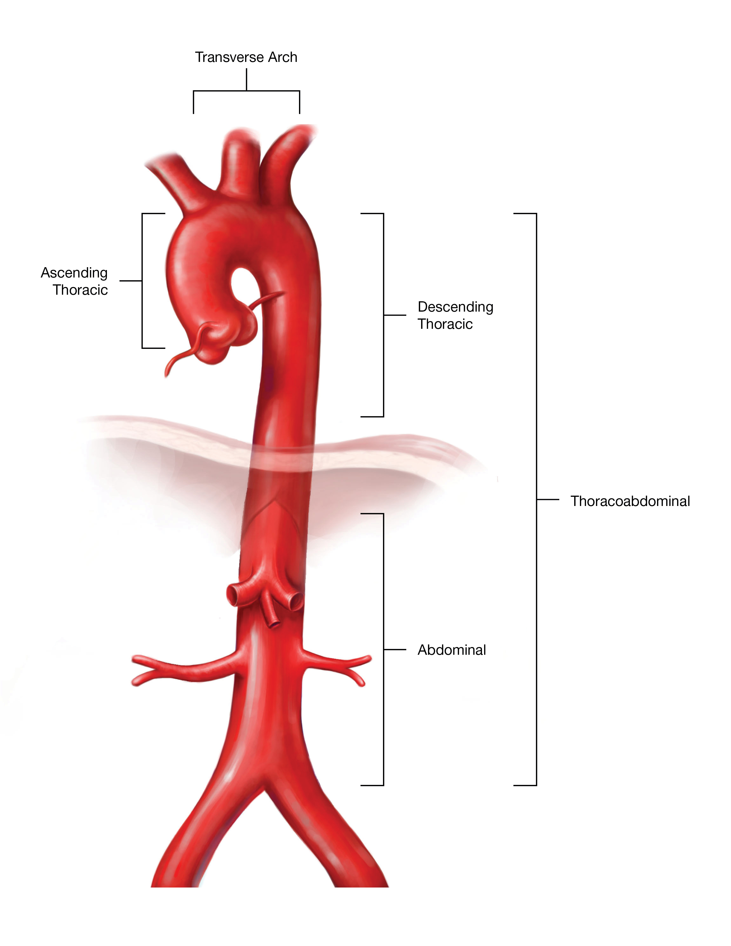 Aortic Aneurysm